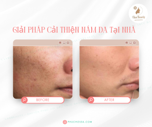 Nám lâu năm có hết được không?