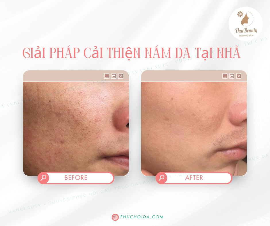 Nám lâu năm có hết được không?